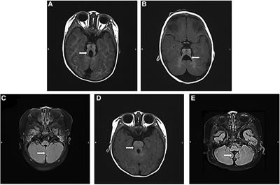 Clinical and genetic characteristics of 36 children with Joubert syndrome